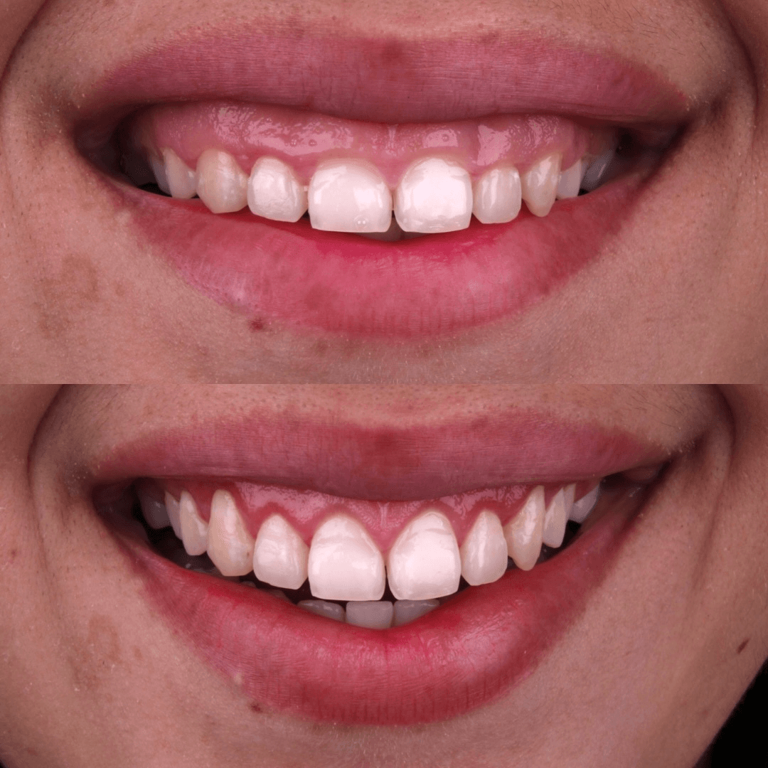 Resultado — Gengivoplastia