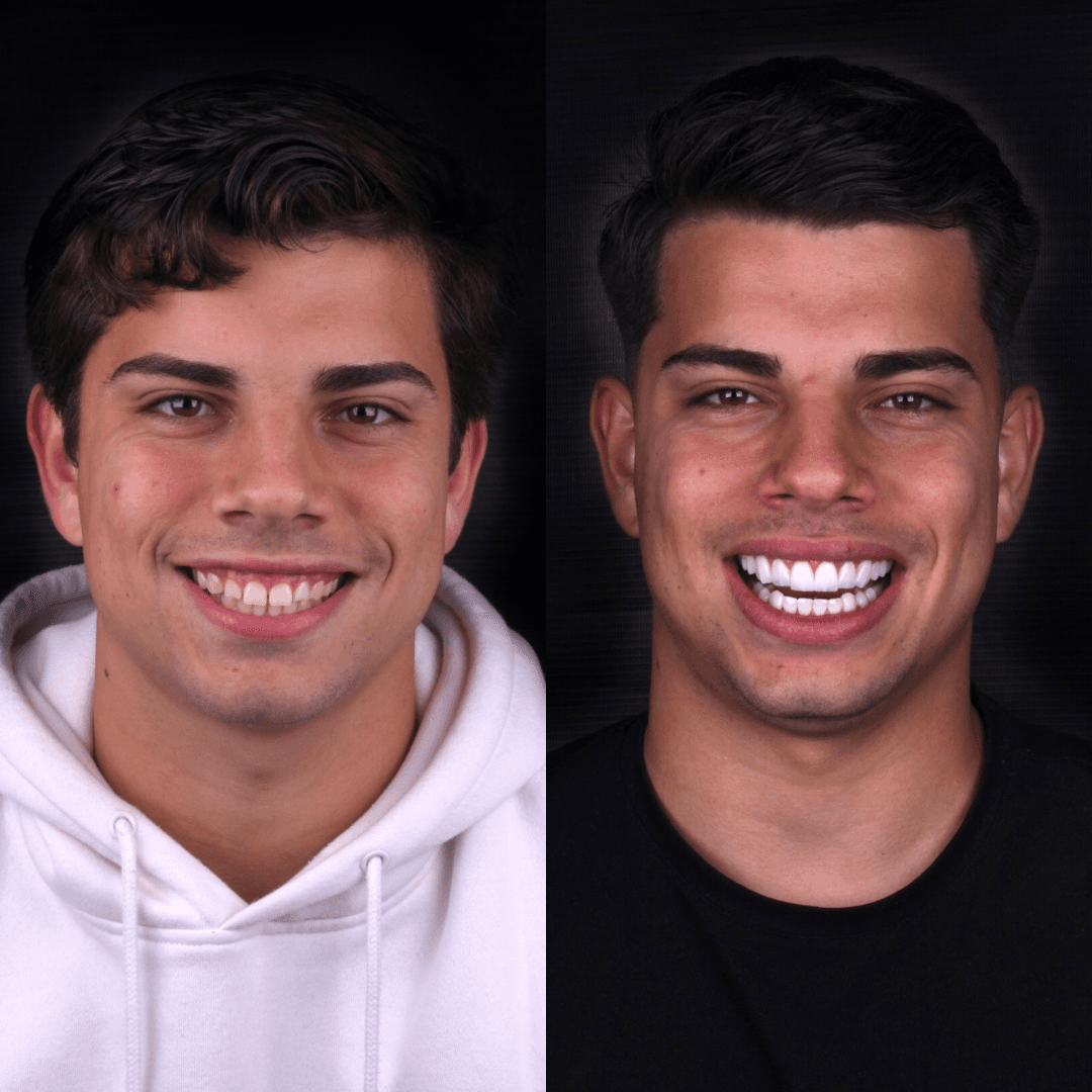 Resultado — Lentes em Resina