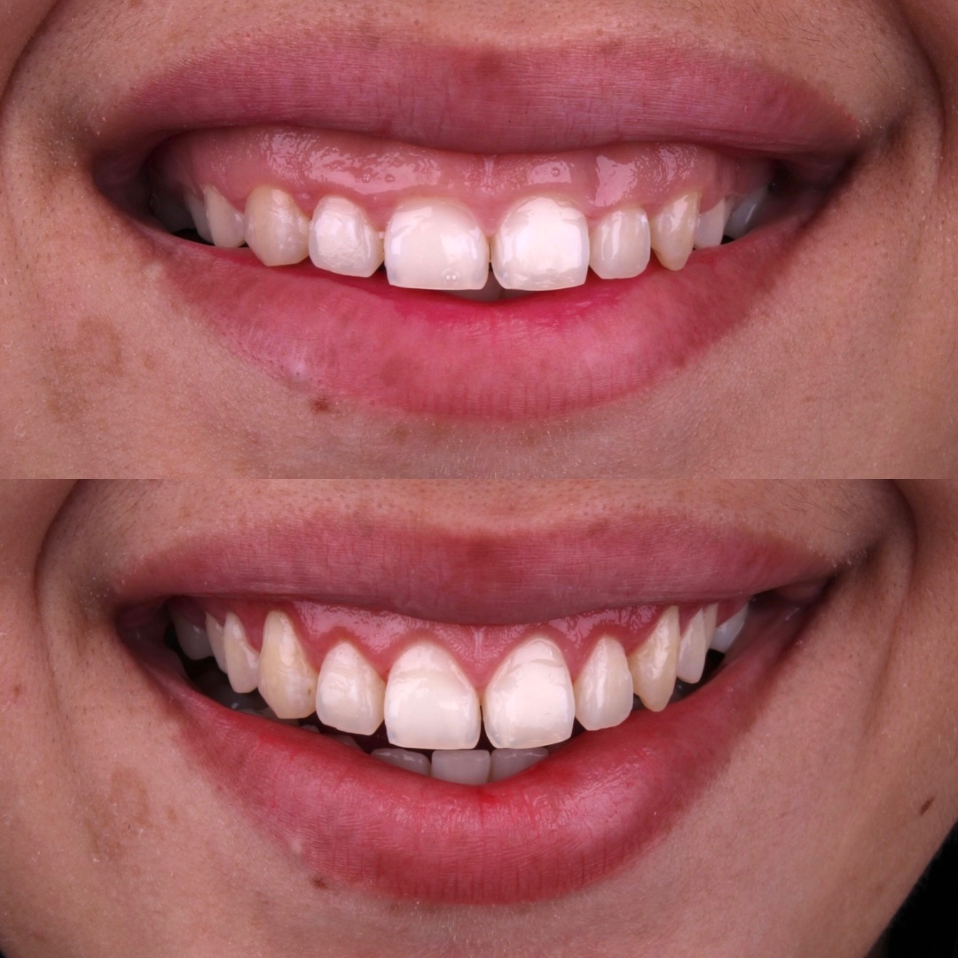 Resultado — Gengivoplastia