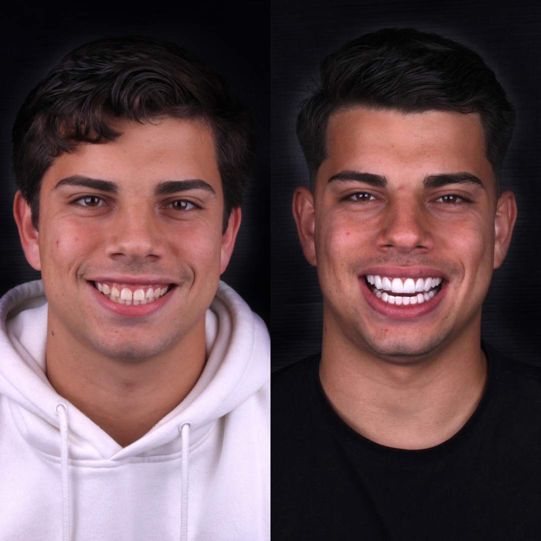 Resultado — Lentes em Resina